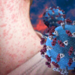 Potential Comeback: Mga dahilan ng biglaang pagtaas ng measles cases