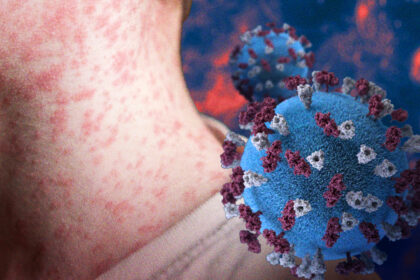 Potential Comeback: Mga dahilan ng biglaang pagtaas ng measles cases