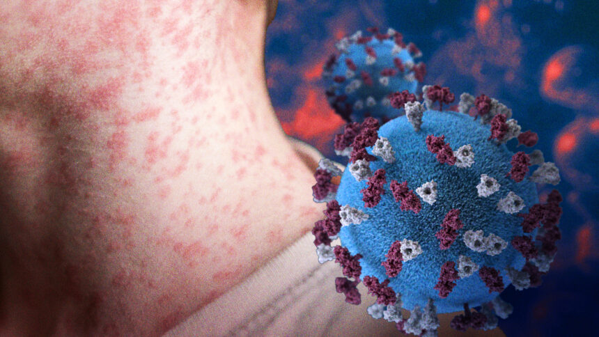 Potential Comeback: Mga dahilan ng biglaang pagtaas ng measles cases