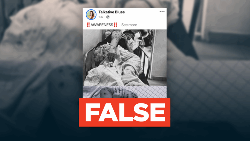 Viral photo of blistered person is NOT a monkeypox case in Iloilo City